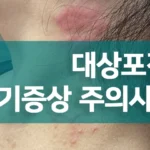 대상포진 초기증상 주의사항 썸네일 이미지