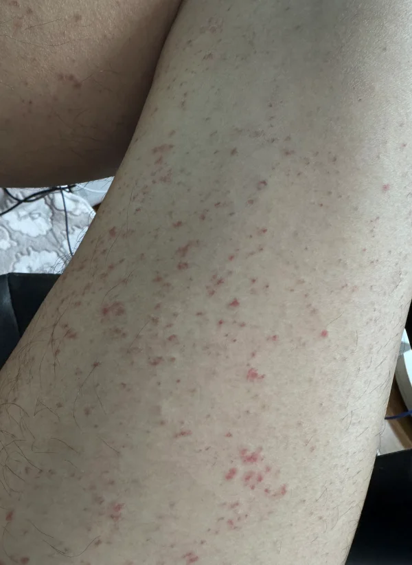 다리 자반증으로 퍼진 붉은 반점과 피부 변색 부위
