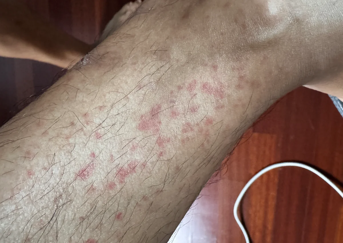 다리 자반증 붉은 반점과 초기 증상 부위 사진