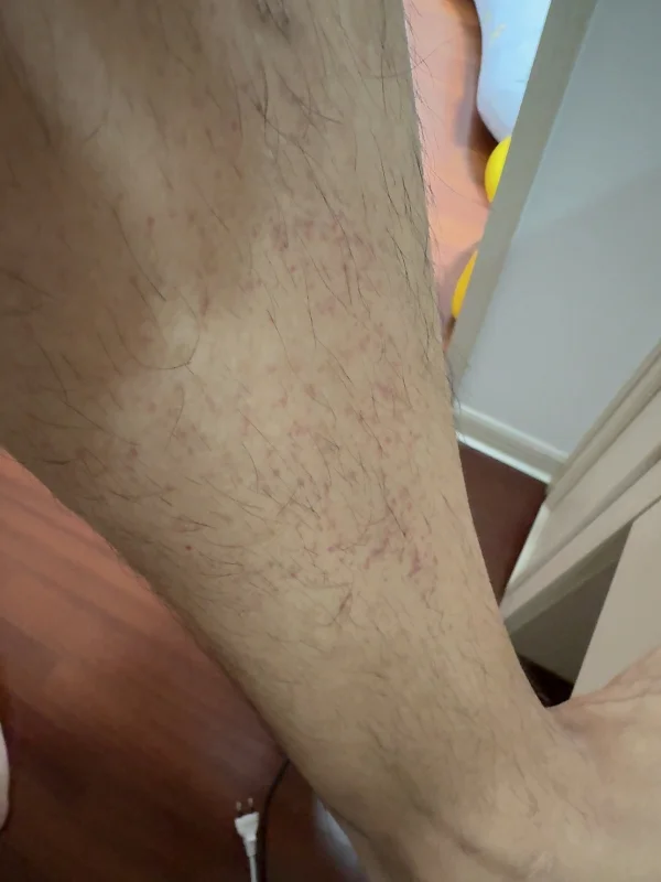 다리 자반증 치료 후 붉은 반점이 사라진 피부 상태